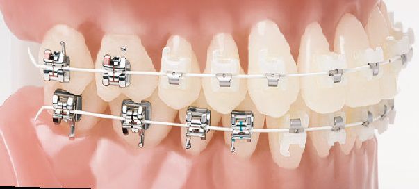 FORESTADENT QUICKLEAR/BIOQUICK 3-3 CERAMIC SL, 45 METAL SL - SMILE SYSTEM